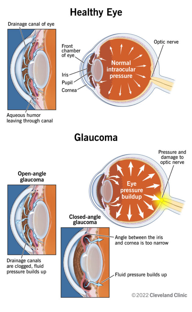 Best Glaucoma Treatment in Jabalpur at Jan Jyoti Super Speciality Eye Hospital